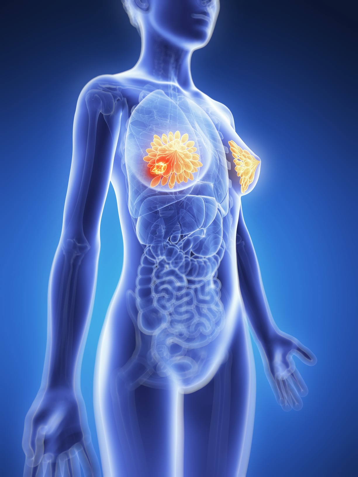 3d rendered illustration - breast cancer